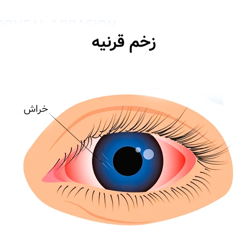 خراش قرنیه و علائم آن